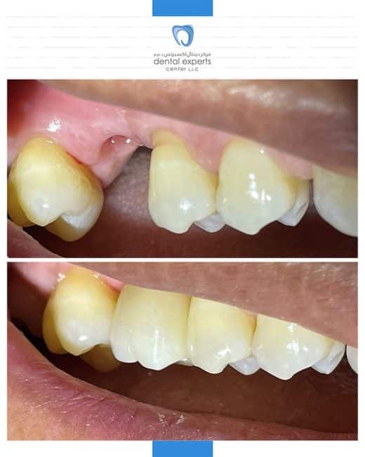 Before and after dental case — Case 1