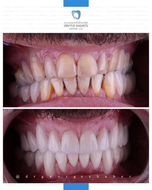 Before and after dental case — Case 2