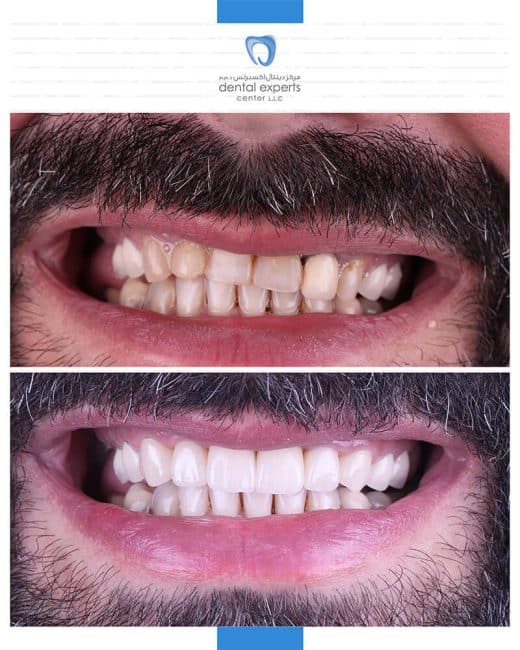 Before and after dental case — Case 4