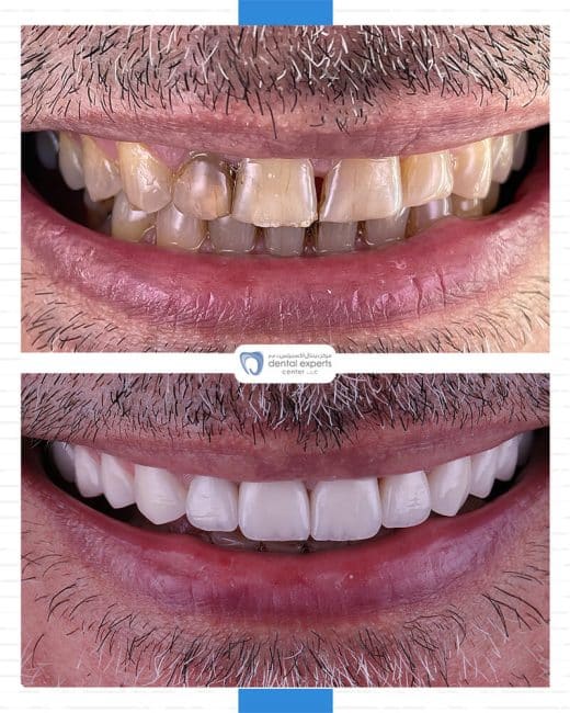 Before and after dental case — Case 12