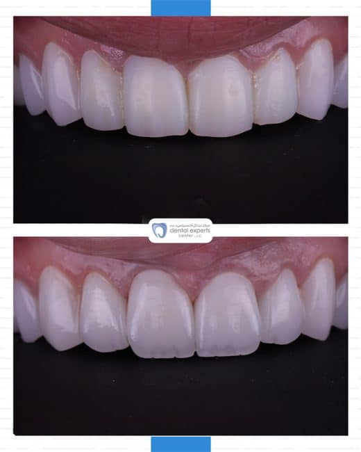 Before and after dental case — Case 20