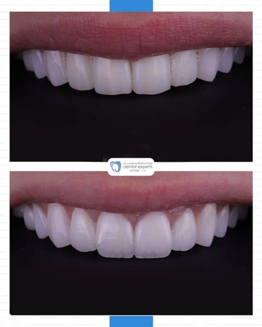 Before and after dental case — Case 21