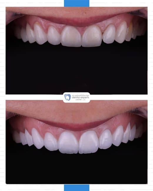 Before and after dental case — Case 22