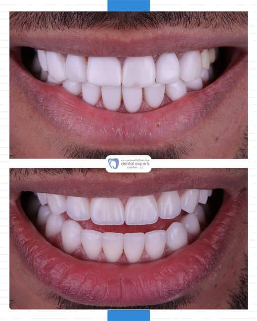Before and after dental case — Case 23