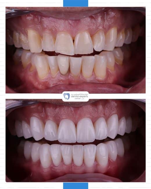 Before and after dental case — Case 24