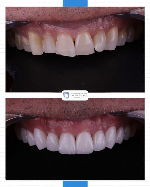 Before and after dental case — Case 25