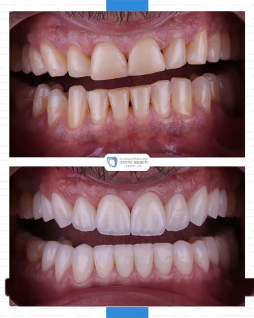 Before and after dental case — Case 26