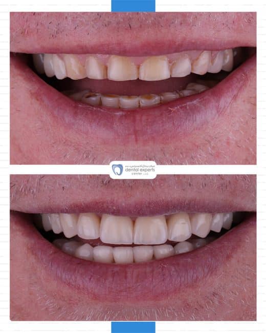 Before and after dental case — Case 27