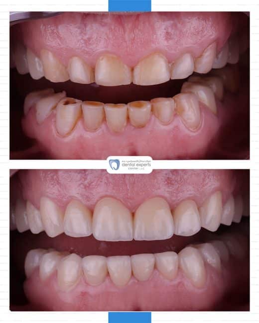 Before and after dental case — Case 28