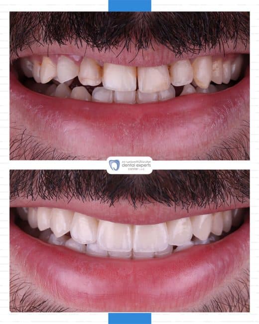 Before and after dental case — Case 29