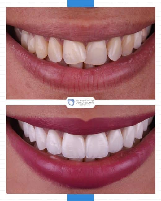 Before and after dental case — Case 30