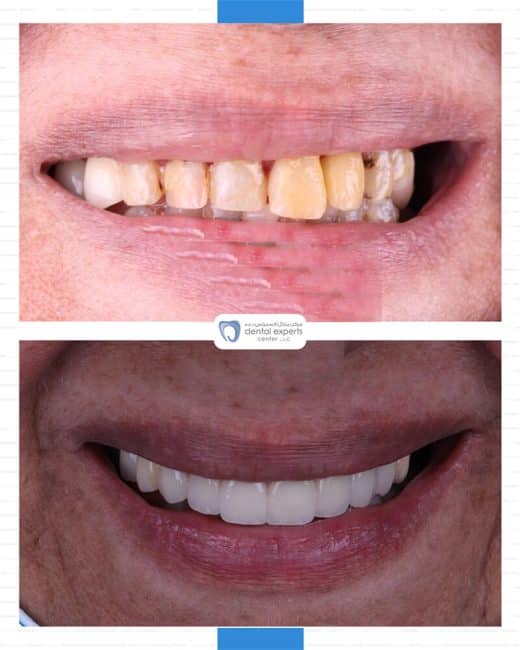 Before and after dental case — Case 31