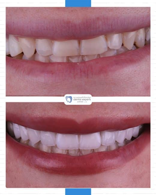 Before and after dental case — Case 13
