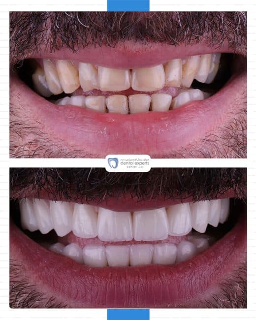 Before and after dental case — Case 14