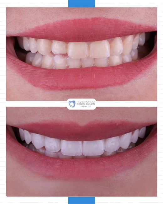 Before and after dental case — Case 15