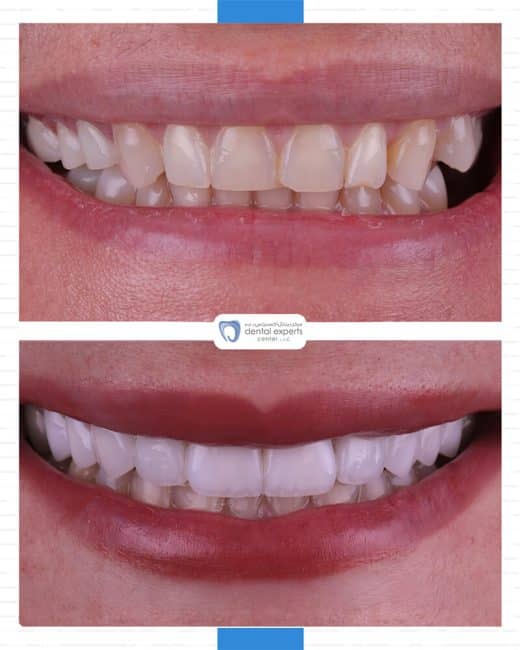 Before and after dental case — Case 16
