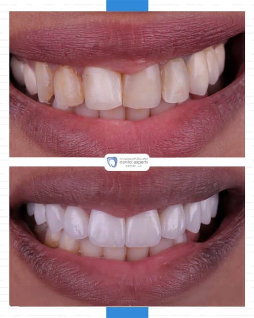 Before and after dental case — Case 17