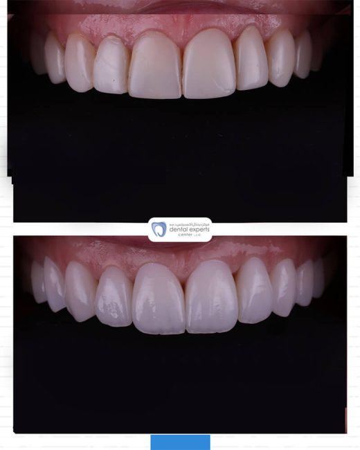 Before and after dental case — Case 18