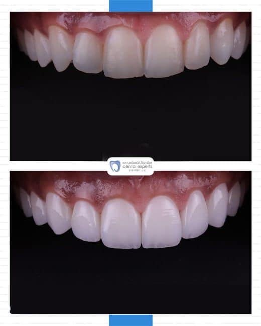 Before and after dental case — Case 19