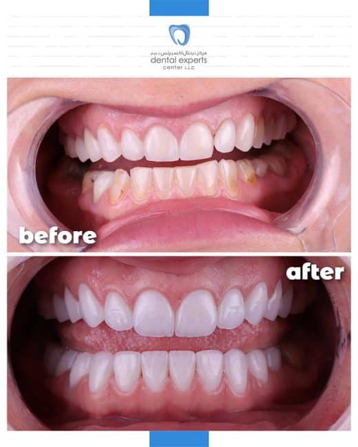 Before and after dental case — Case 7