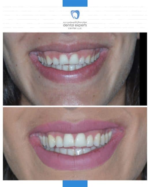 Before and after dental case — Case 5