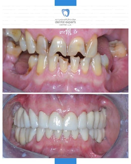 Before and after dental case — Case 6