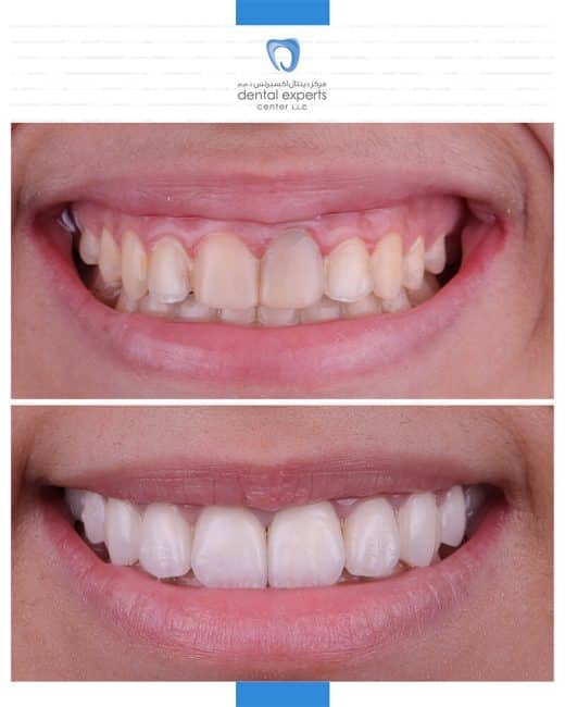 Before and after dental case — Case 8