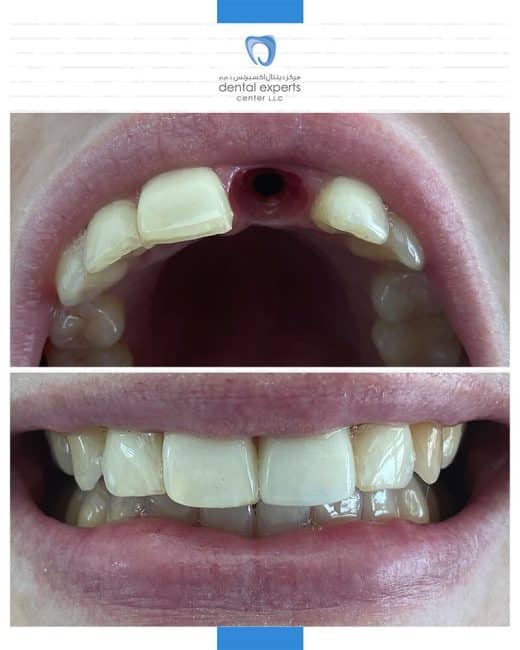 Before and after dental case — Case 9