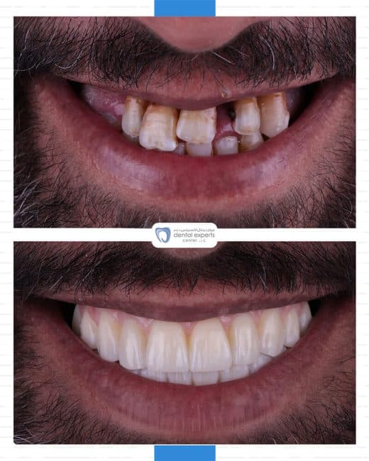 Before and after dental case — Case 32