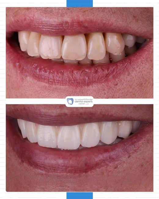 Before and after dental case — Case 33