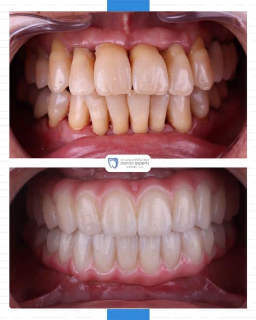 Before and after dental case — Case 34