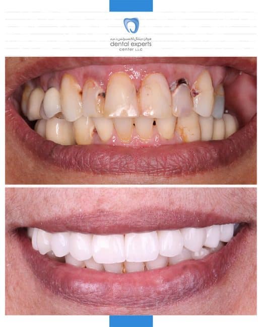 Before and after dental case — Case 10