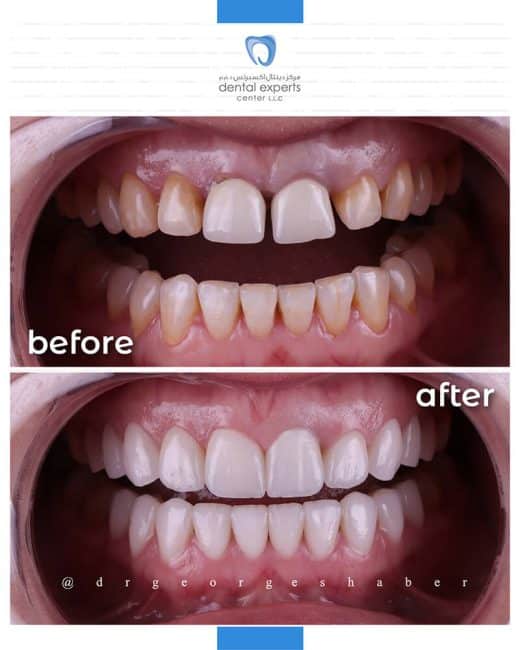 Before and after dental case — Case 11