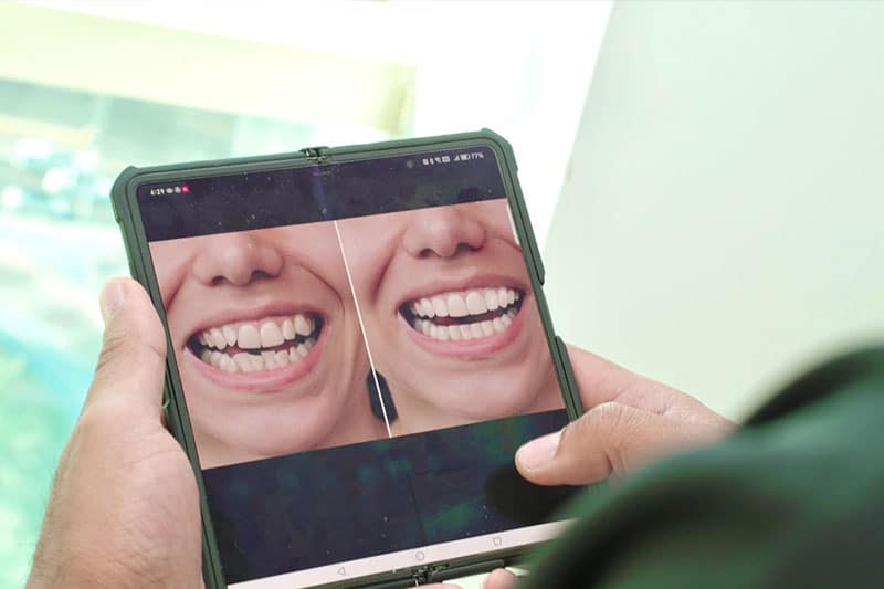 Clear Aligners